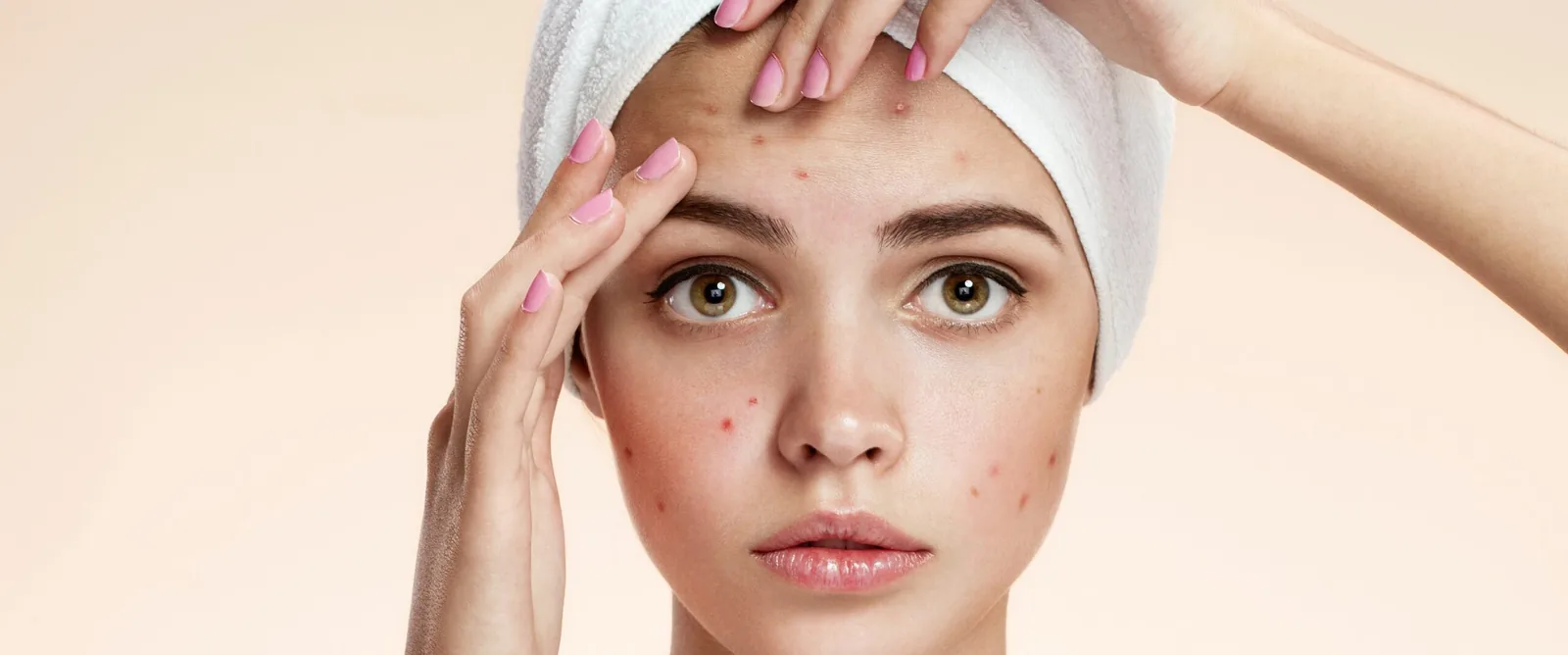 Acne Treatment