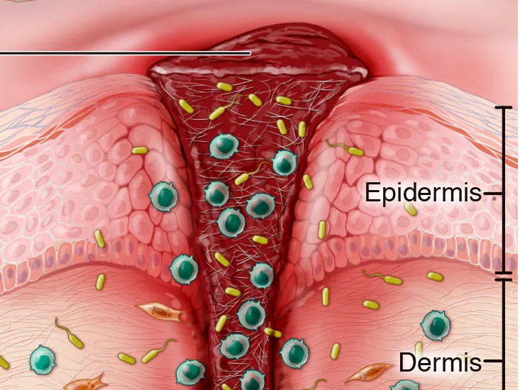 Illustration of skin inflammation and healing